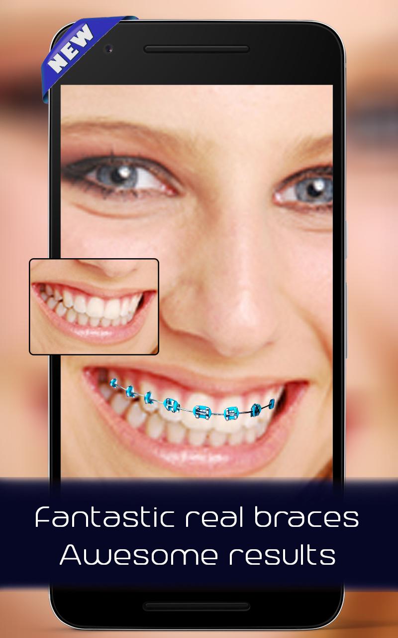 Braces on teeth Photo editor