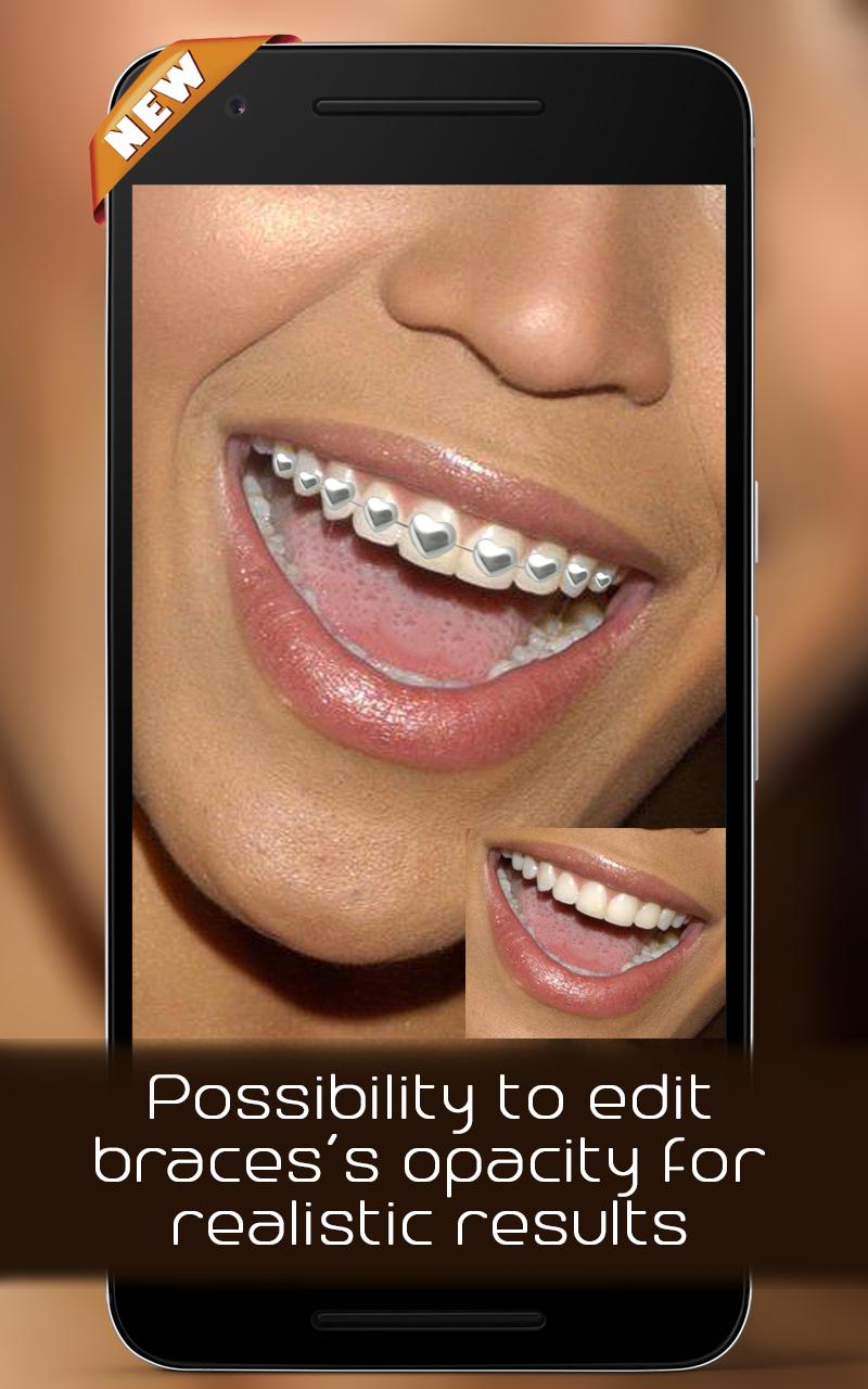 Braces on teeth Photo editor