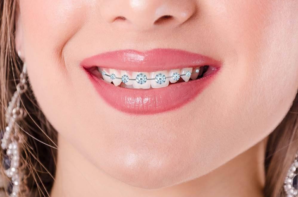 Real Braces Teeth