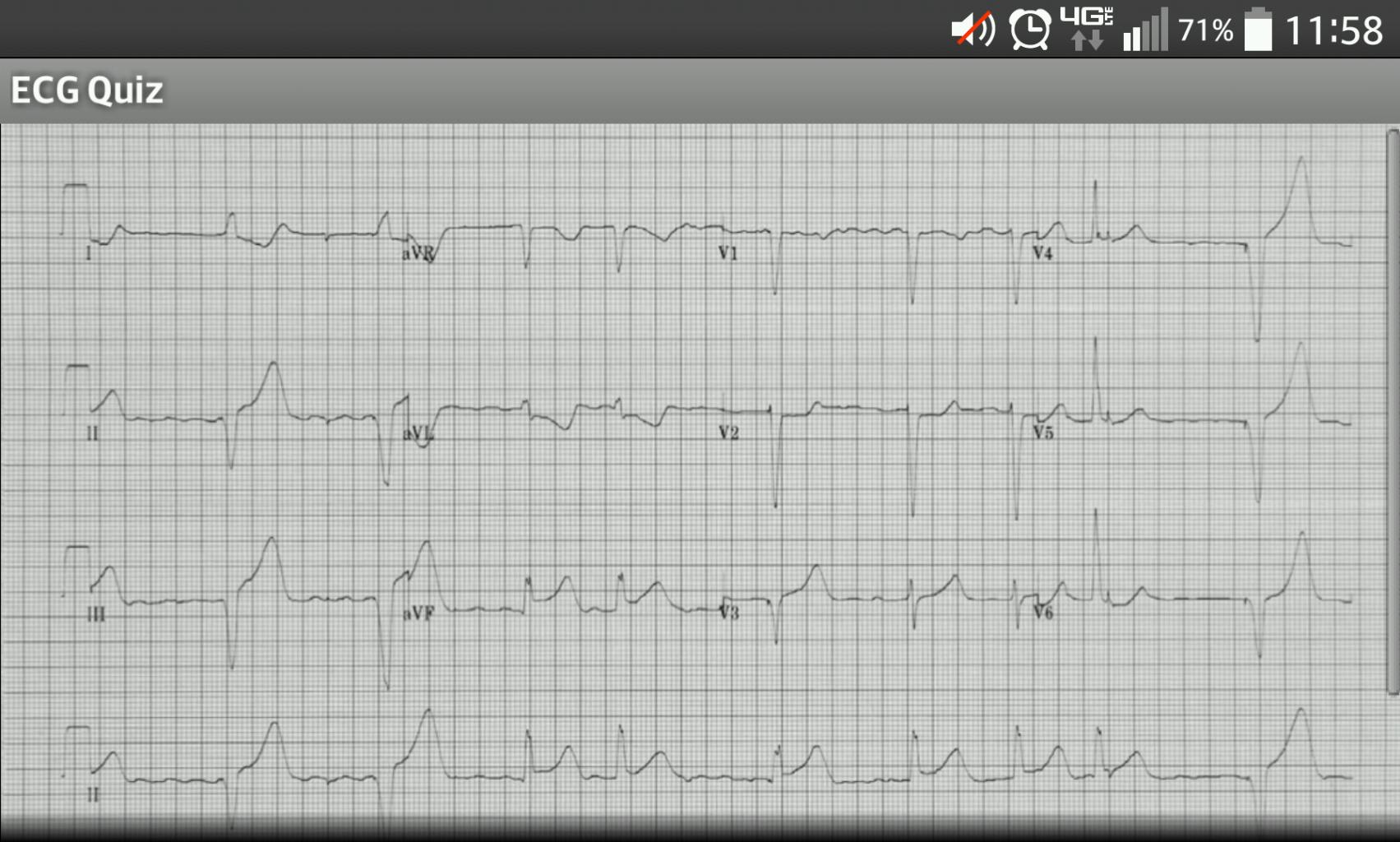ECG Quiz