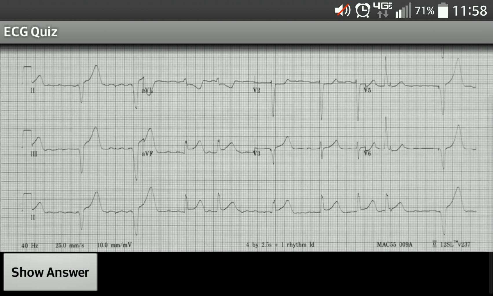 ECG Quiz